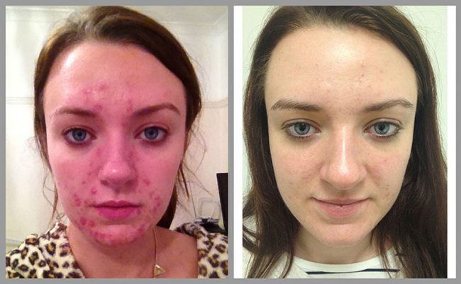 Acne Laser Clinic